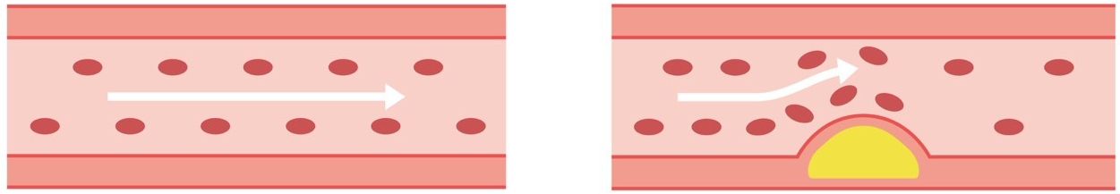 心筋梗塞とは?2
