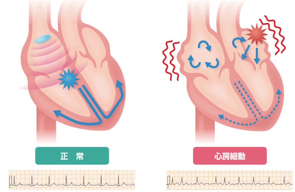 心房細動とは?