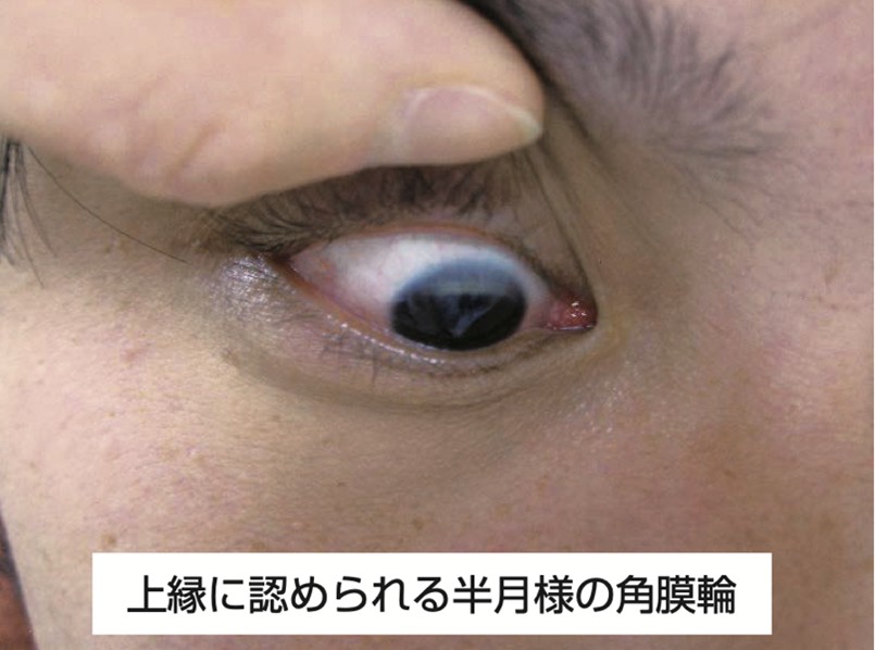 角膜輪