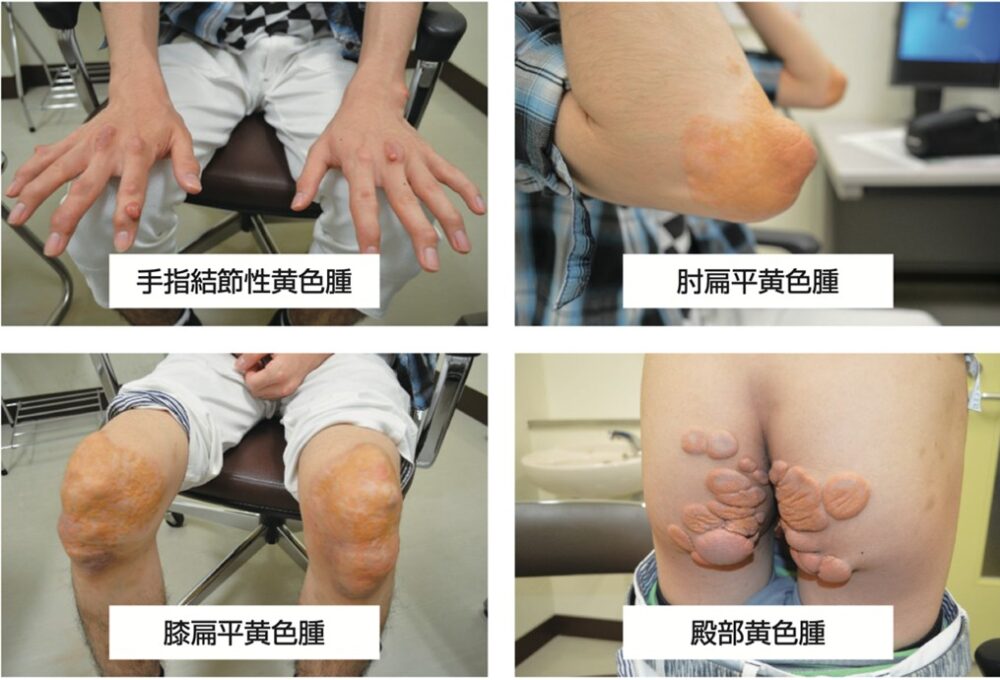 腱黄色腫