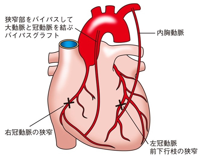 2 冠動脈バイパス手術(CABG)