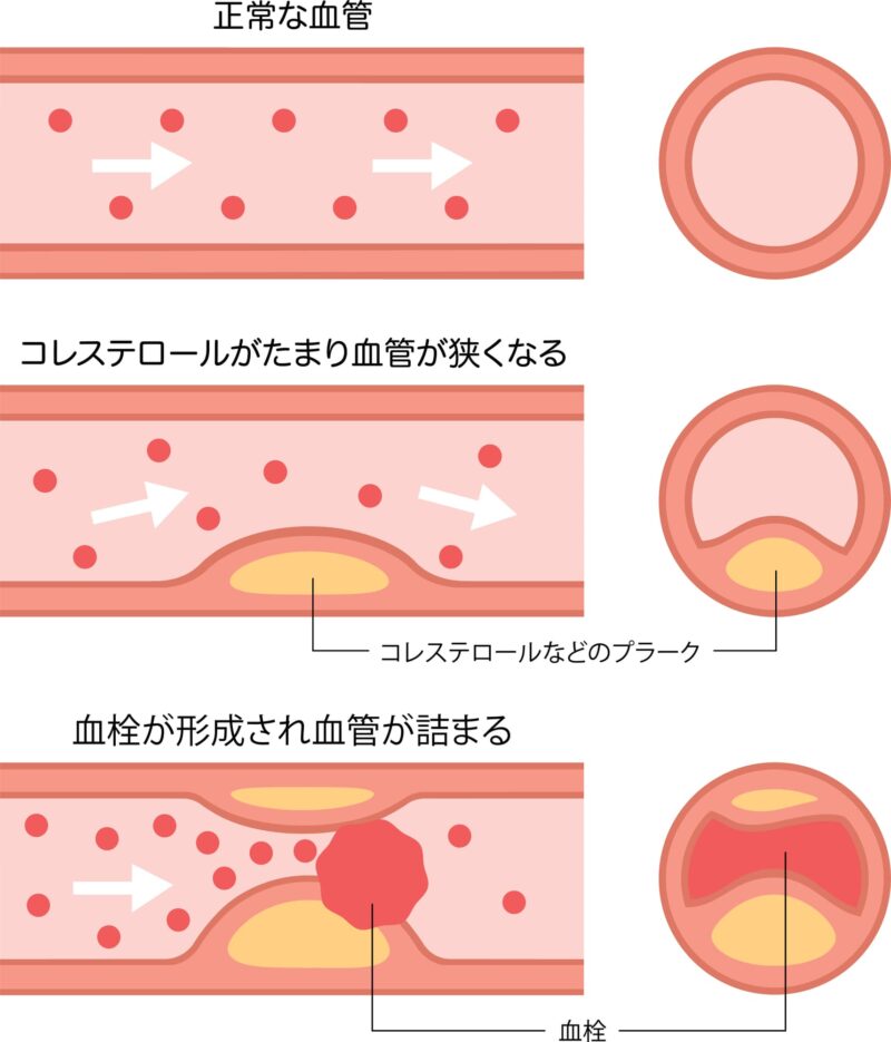 脂質異常症(高脂血症)とは？