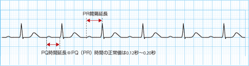 ②房室ブロックとは
