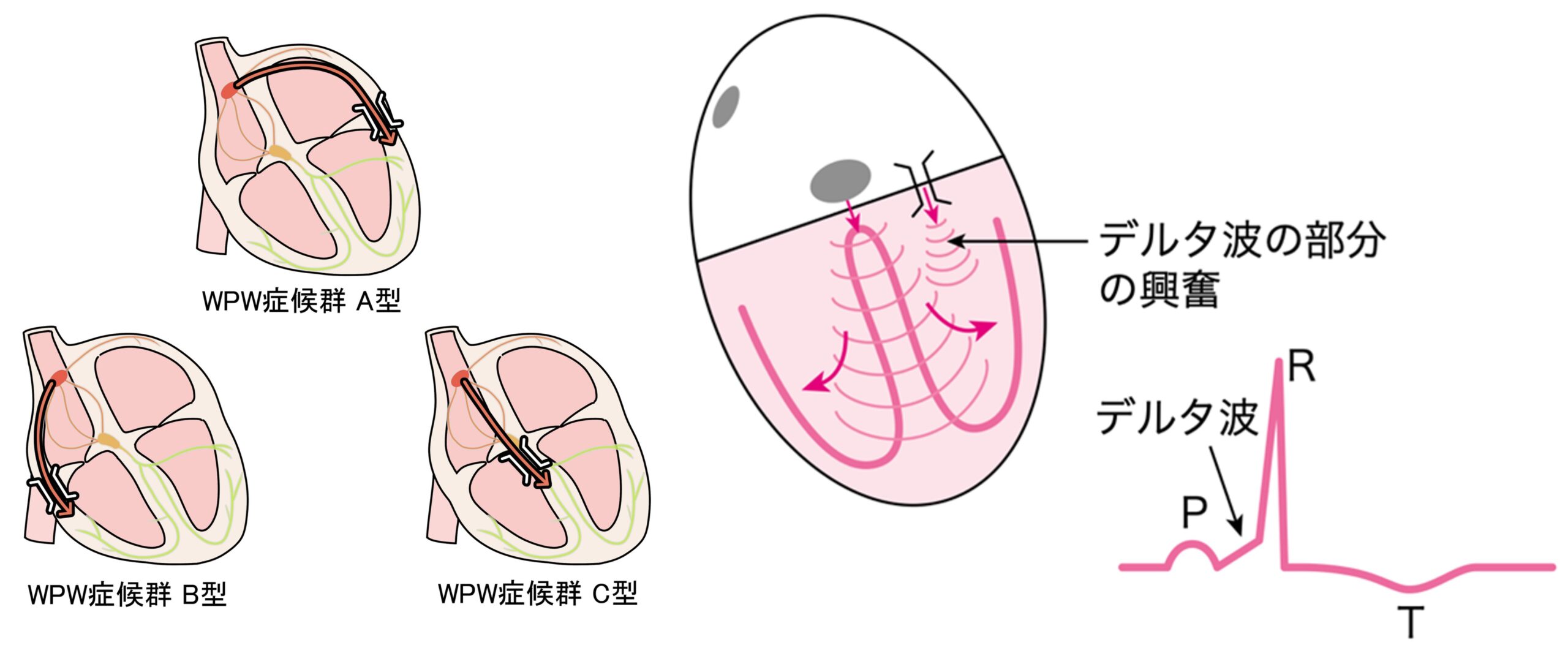 ③WPW症候群