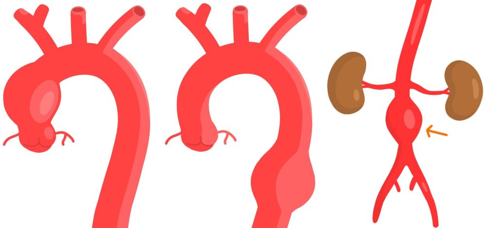 大動脈瘤とは？