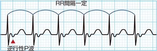 ②発作性上室性頻拍(PSVT : paroxysmal supraventricular tachycardia)