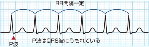 ②発作性上室性頻拍(PSVT : paroxysmal supraventricular tachycardia)2