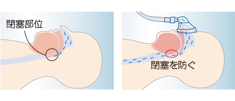 CPAPの原理