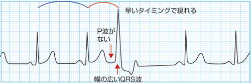 ② 心室期外収縮とは?