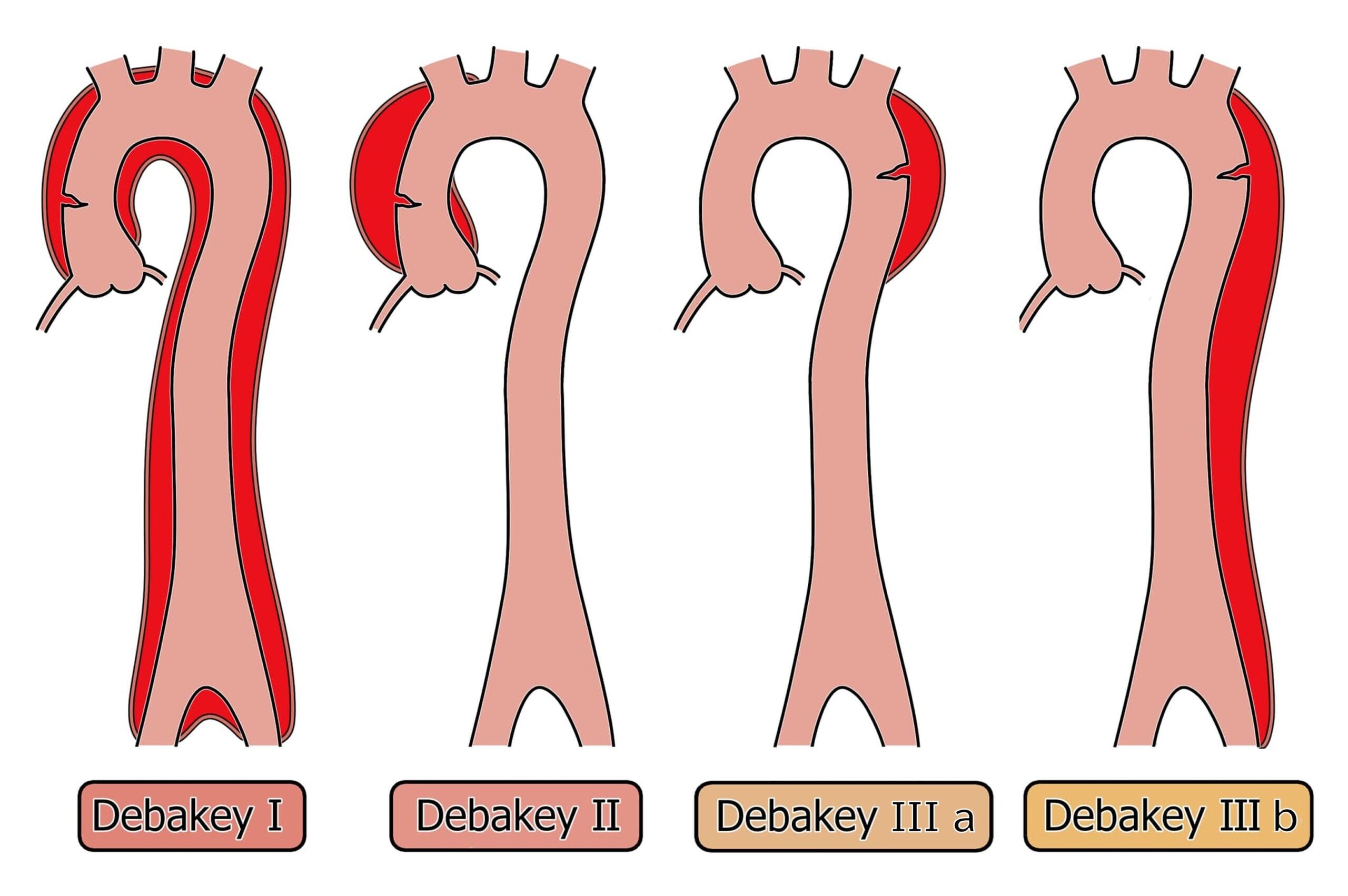 DeBakey分類
