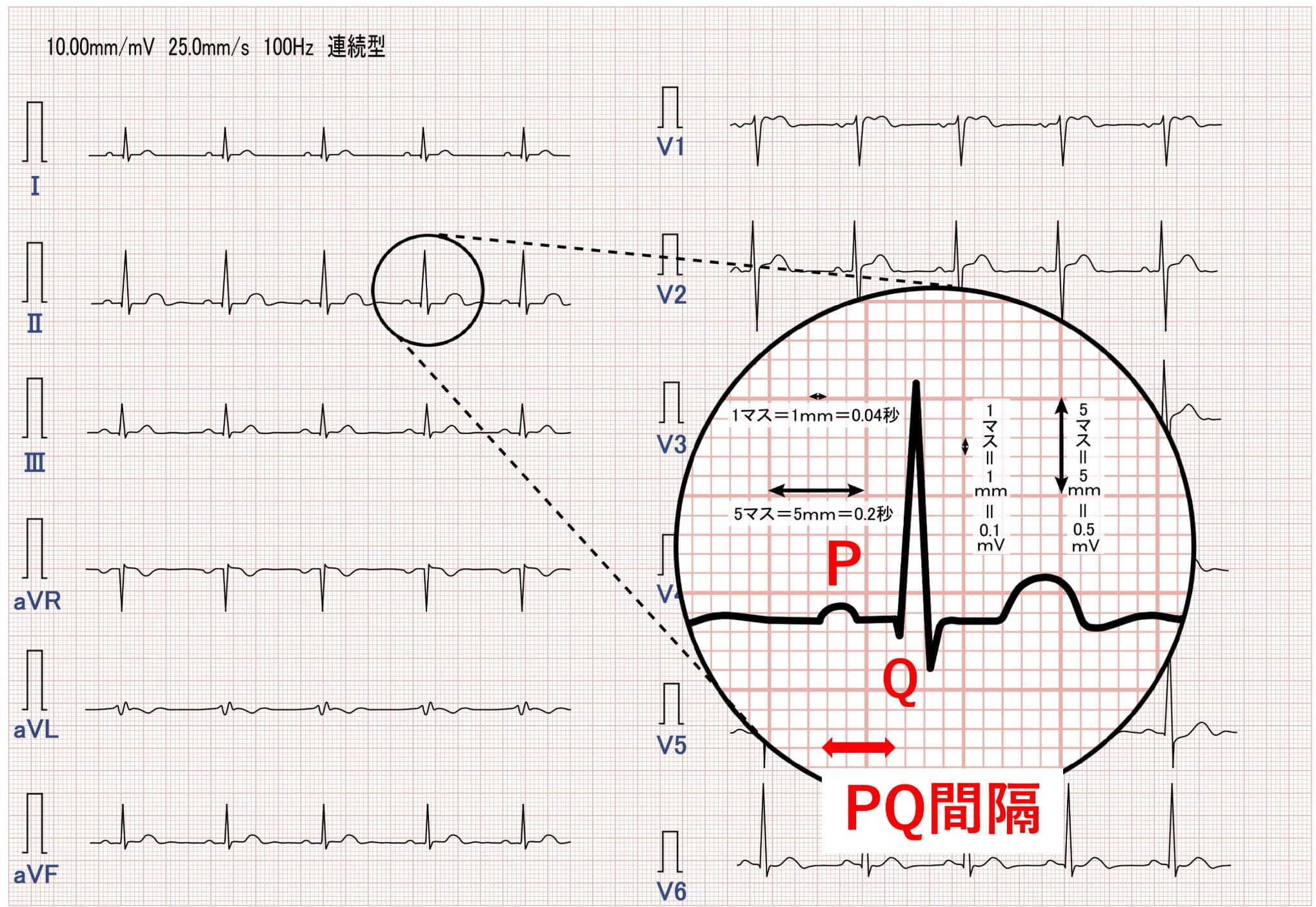 PQ間隔